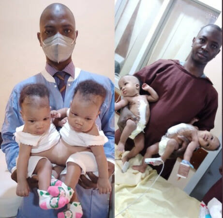 Conjoined female twins separated at the University of Ilorin Teaching Hospital